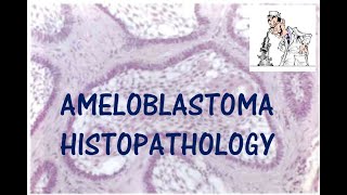 AMELOBLASTOMA HISTOPATHOLOGY I ORAL PATHOLOGY [upl. by Dambro935]