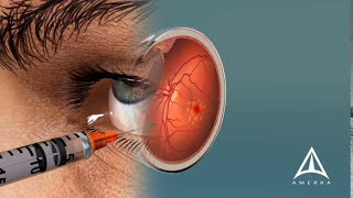 How Macular Degeneration Affects Your Vision  3D animation [upl. by Aneeled]