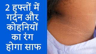 गर्दन और कोहनियों का कालापन दूर करने का आसान उपाय  Home Remedies for Black Neck And Elbows  NBT [upl. by Tucky]