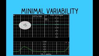 Topic 26 Intrapartum Fetal Surveillance [upl. by Yendys720]