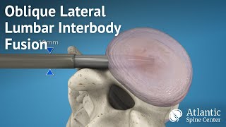 Oblique Lateral Lumbar Interbody Fusion OLLIF [upl. by Dominick]