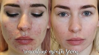 ROACCUTANE MONTH 7 Update  Side Effects [upl. by Oinotnaocram419]