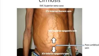 Interpreting abdominal wall veins [upl. by Akerley920]