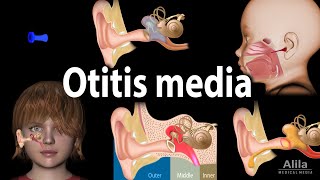 Otitis Media Anatomy Pathophysiology Risk Factors Types of OM Symptoms and Treatment Animation [upl. by Landa]