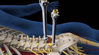 Lumbar Fusion of L5 S1 Animation [upl. by Seigel]