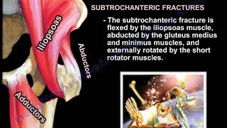 Fixation of Intertrochanteric Fractures Tips  Tricks amp Avoiding Pitfalls [upl. by Fortna675]