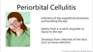 Periorbital cellulitis [upl. by Phares534]