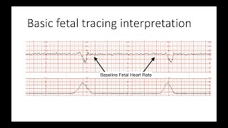 Interpreting Intrapartal fetal heart rate tracings [upl. by Bryon]