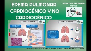 EDEMA PULMONAR CARDIOGÉNICO Y NO CARDIOGÉNICO  GuiaMed [upl. by Anerak]