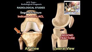 ACL Tears Radiological Evaluation  Everything You Need To Know  Dr Nabil Ebraheim [upl. by Ainek180]