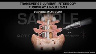 Transverse Lumbar Interbody Fusion at L45 amp L5S1  Medical Animation [upl. by Nero]