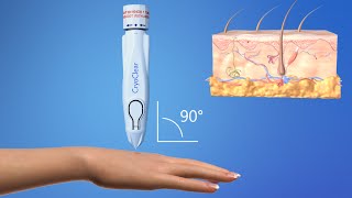 CryoConcepts  CryoClear Device  3D Medical Animation [upl. by Guerra]