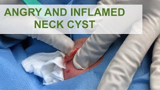 Angry Inflamed Neck Cyst  Dr Derm [upl. by Wrennie]