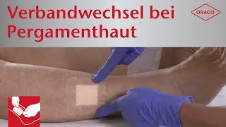 Schmerzfreier Verbandwechsel bei Pergamenthaut  Wundauflagen mit SilikonHaftrand [upl. by Ardekahs]