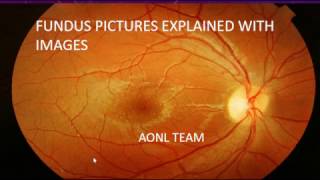 Fundus images explained by an ophthalmologist [upl. by Brandais746]